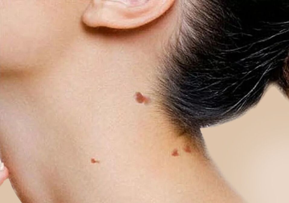 Das Auftreten von Papillomen am Hals nach der Aktivierung von HPV im Körper. 