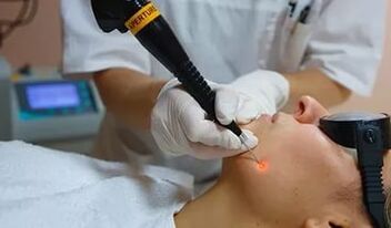 Ein wirksames Verfahren zur Entfernung von Papillomen im Gesicht mit einem Laser. 
