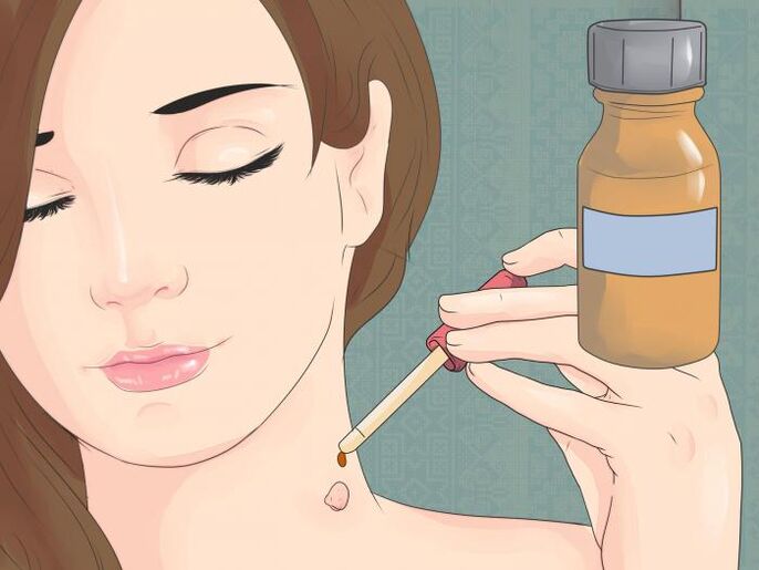 Verwenden Sie das Medikament in Form einer Lösung, um Papillom am Hals zu entfernen. 