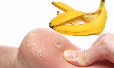 Bananenschale für die Behandlung einer Plantarfarm