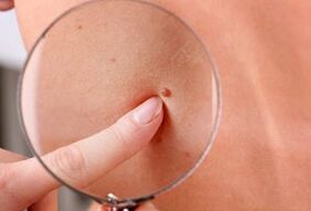 Gründe für das Auftreten von Papillomen am menschlichen Körper.