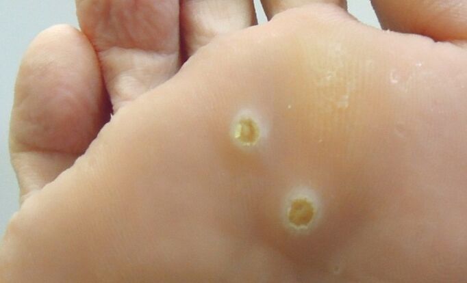 Plantarpapillome am Fuß